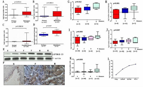 LAPTM4B is overexpressed in PCa and is associated with disease progression.