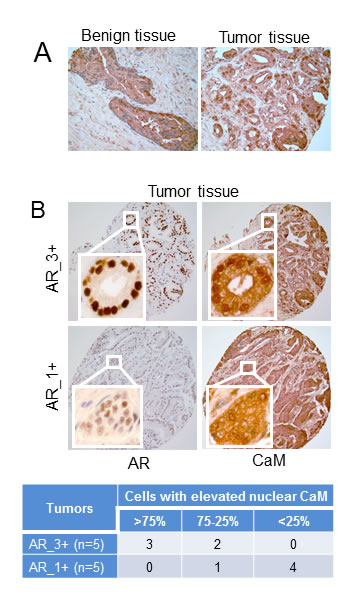 Immunohistochemistry of CaM and AR in human prostate tumor and non-tumor tissues.