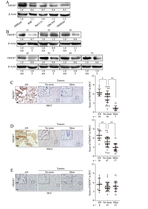 FBXW7 expression deficiency correlates with CCA metastasis.