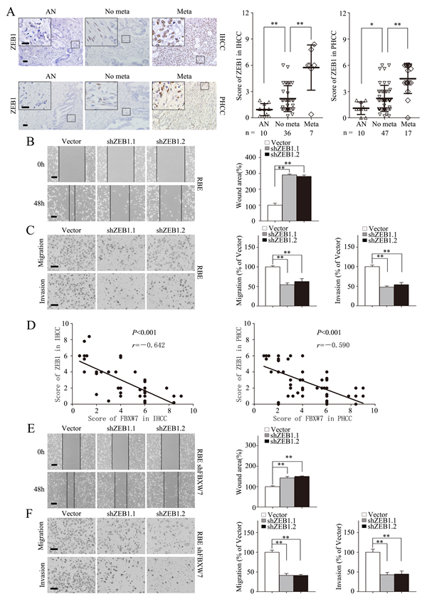 ZEB1 mediates FBXW7/mTOR signaling related EMT and metastasis in CCA.