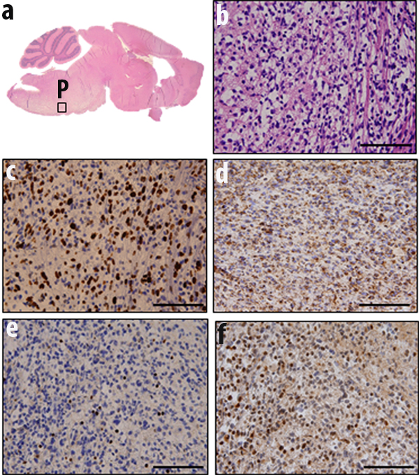 Fig.5: Orthotopic injection of DMSO preserved cells results in diffuse pontine tumors.