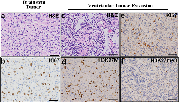 Fig.6: Ventricular extended tumor retains characteristics of primary pontine tumor.