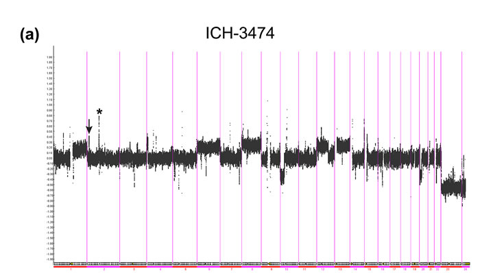 Copy number heterogeneity in a bilateral WT case.