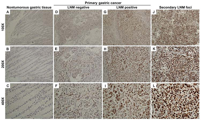 CREB1 expression in nontumorous gastric mucosa, primary gastric cancer tissues and secondary lymph node metastatic foci by immunohistochemistry.