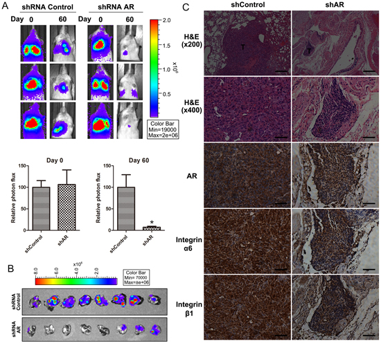 Depletion of AR suppresses metastasis of chondrosarcoma cells to the lung in mouse model.