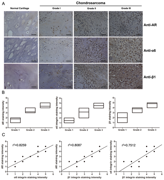 The expression levels of AR and &#x03B1;6&#x03B2;1 integrin are positively correlated with histopathological grade in human chondrosarcoma tissues.