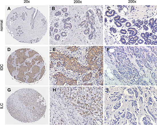Immunohistological detection of sortilin in breast cancers.