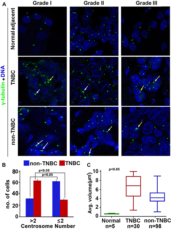 Comparison of extent of centrosome amplification in grade-matched TNBC and non-TNBC patients.