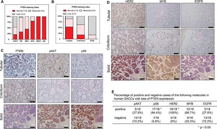 PTEN expression and its correlation with pAKT, pS6, HER2, MYB and EGFR in human salivary gland tumors.