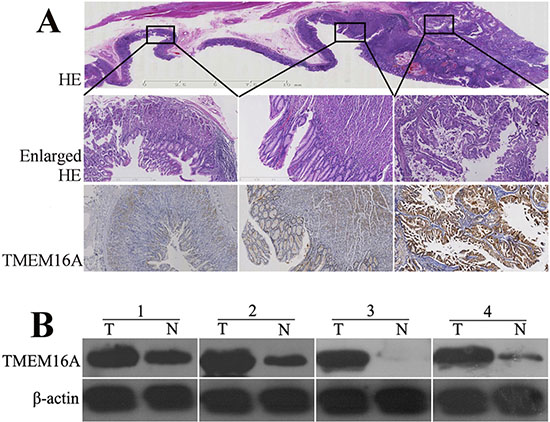 The expression of TMEM16A protein in gastric cancer, adjacent and normal tissues.