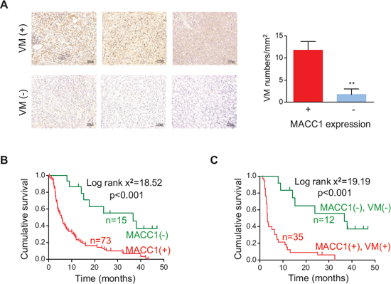 Relation between MACC1 expression and VM density in human GC tissues and their combined influence on survival.