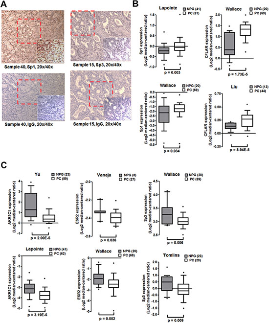 Expression of Sp1, Sp3, c-FLIP, AKR1C1 and ER&#x03B2; in human prostate tumors.