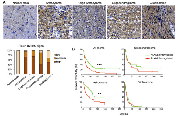 Plexin-B2 expression in glioma correlates with survival.