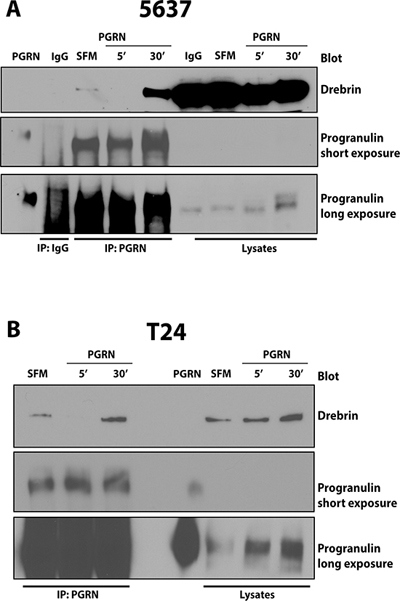 Progranulin coprecipitates with drebrin in 5637 and T24 urothelial cancer cells.