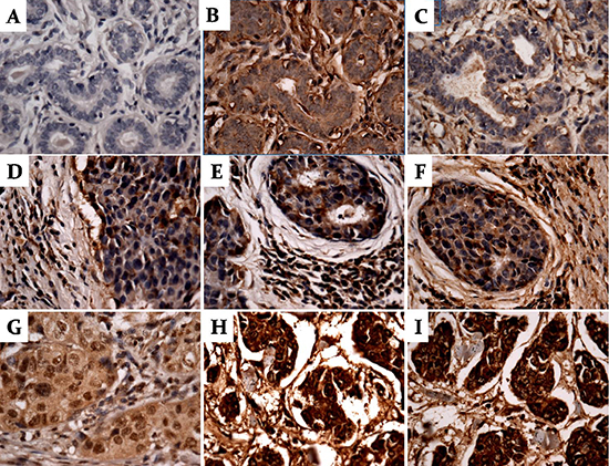 Expression of PARA1, BRCA1 and BRAC2 in breast cancer and adjacent normal tissues by immunohistochemistry.