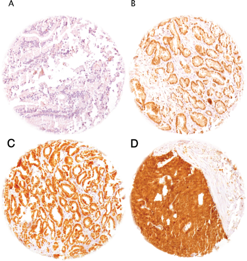 Representative pictures of HOXB13 immunostaining in prostate cancer.