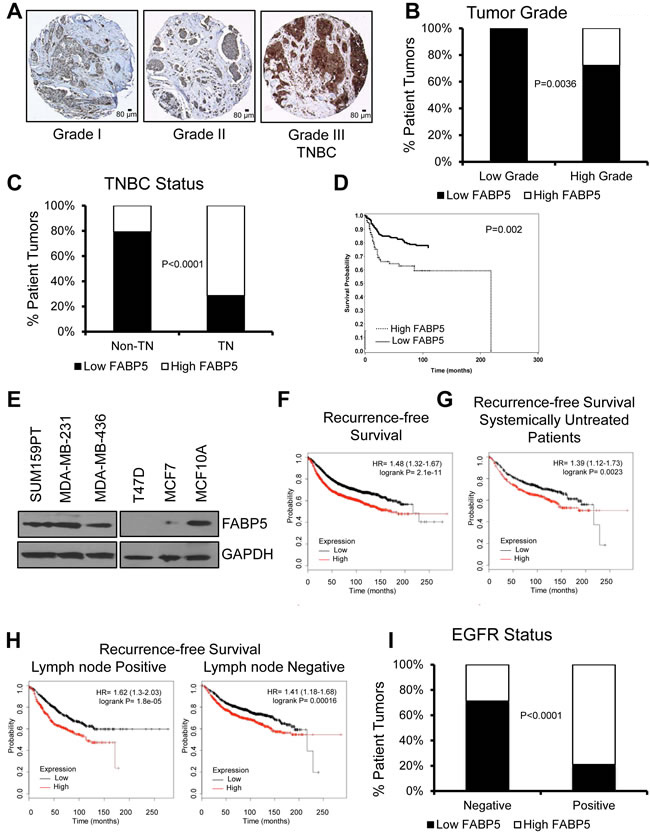 FABP5 expression correlates with worse prognosis in patient samples.