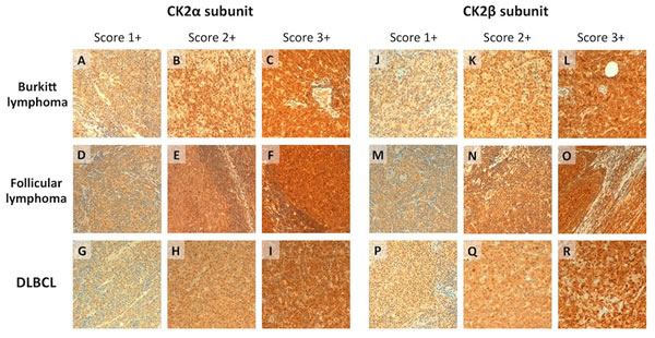 CK2&#x3b1; and CK2&#x3b2; expression by immunohistochemistry in FL, BL and DLBCL.
