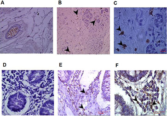 Enrichment of infiltrating CD56+ natural killer (NK) cells in colon and breast tumors.