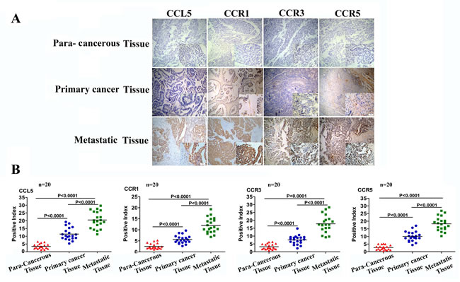 CCL5 and CCR1/CCR3/CCR5 expression is correlated with tumor invasiveness.