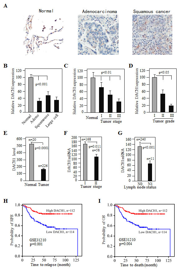 Decreased DACH1 expression in lung adenocarcinoma inversely correlated with tumor stage and related to survival.