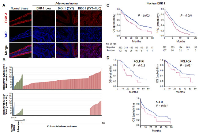 Nuclear DKK-1 expression decreases during CRC progression and associates with shorter patient PFS and OS.