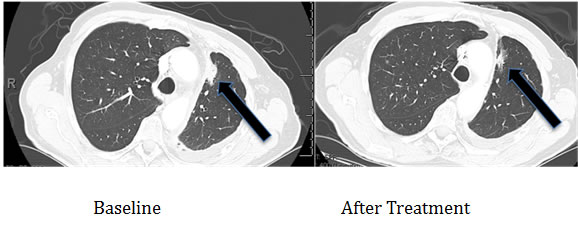 Computerized tomographic scan of the lungs of Patient #1 (Table 2) with EGFR aberration in exon 20 (D770&gt;GY)) before and four months after treatment with a cetuximab-based regimen shows tumor regression.