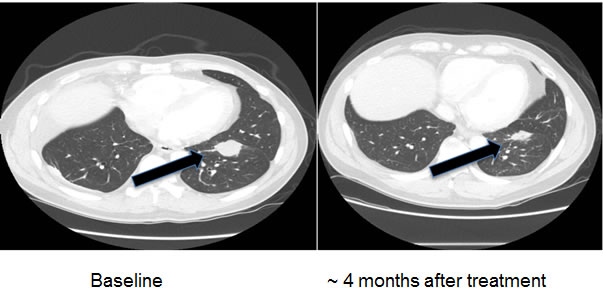 Computerized tomographic scan of the lungs of Patient #2 (Table 2) with EGFR exon 20 aberration D770_P772del_insKG before and after treatment with a cetuximab-based regimen shows tumor regression.