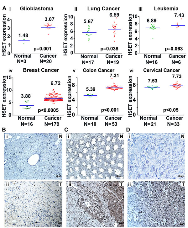 HSET overexpression in human carcinomas.