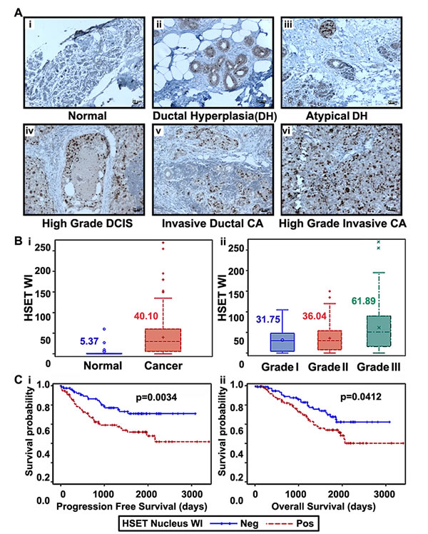 HSET overexpression correlates to increased aggressiveness and poorer clinical outcomes.