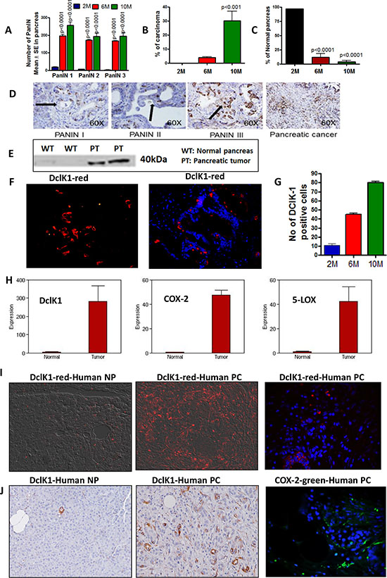 Activation of inflammation and CSCs during progression of pancreatic cancer.