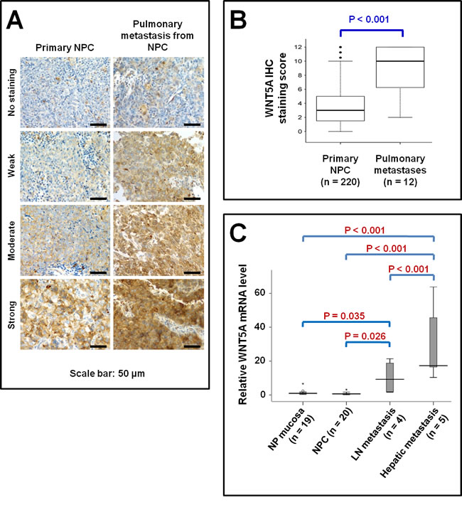 Elevated WNT5A expression in metastatic NPC tissues.