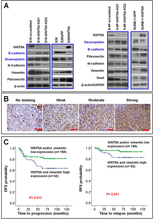 WNT5A promotes EMT in NPC cells, and this procedure associates with poor patient survival.