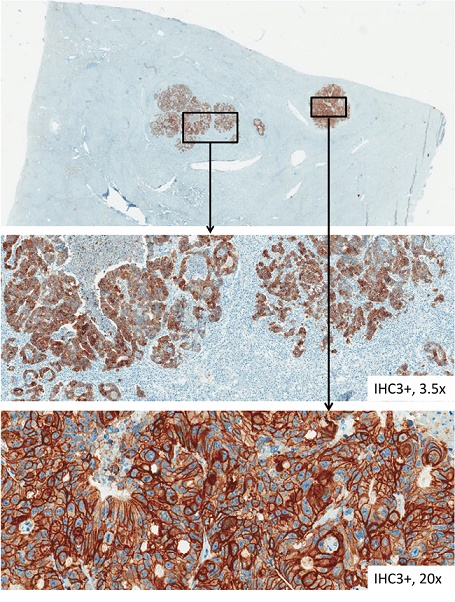 HER-3 immunohistochemical staining of tissue samples from liver metastases.