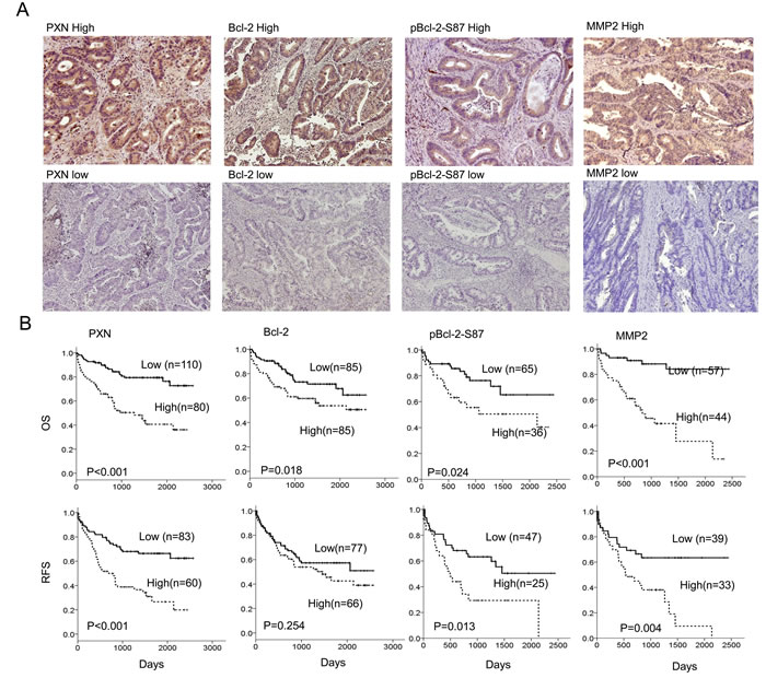 Expression of PXN, Bcl-2, pBcl-2-S87, and MMP2 in colorectal tumors is associated with reduced patient OS and RFS.