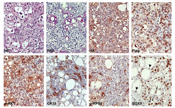 Molecular features of mixed hepatocellular/cholangiocellular tumors developed in PIK3CA/Yap mice.