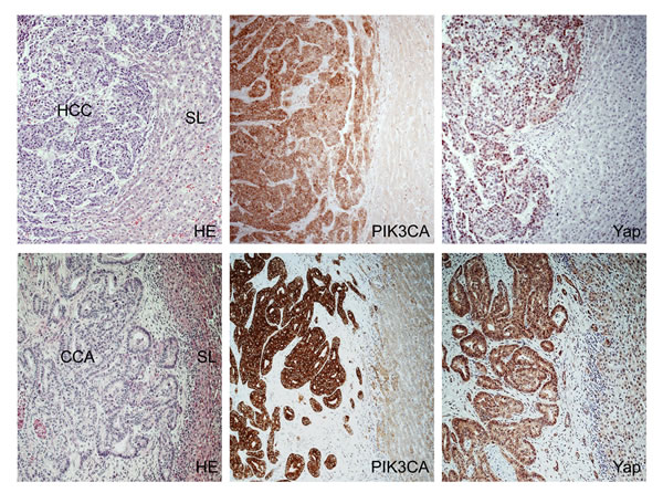 Immunohistochemical patterns of PIK3CA and Yap in human hepatocellular carcinoma (HCC) and cholangiocarcinoma (CCA).