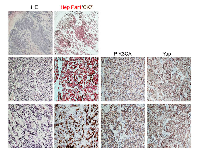 Immunohistochemical patterns of PIK3CA and Yap in a mixed human hepatocellular carcinoma (HCC)/cholangiocarcinoma (CCA).
