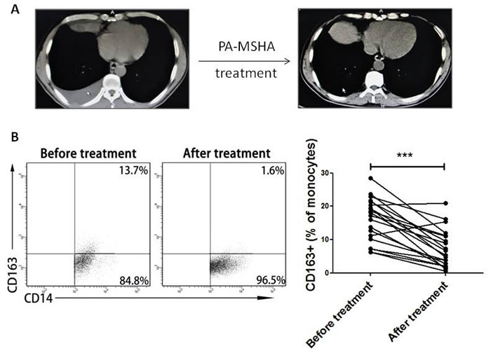 Change of CD163+ TAMs frequency before and after treatment with PA-MSHA in clinic.