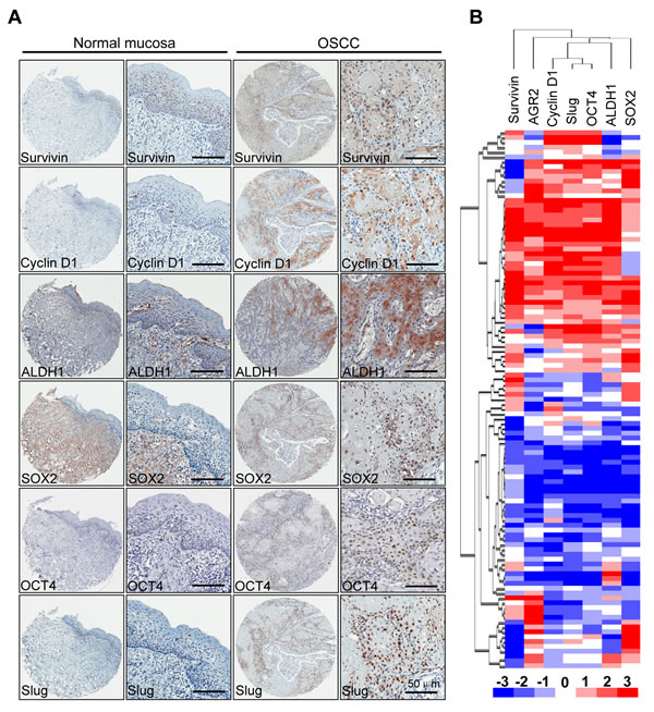 Correlation of Survivin, Cyclin D1, ALDH1, Oct4, Sox2 and Slug in human HNSCC tissue array .