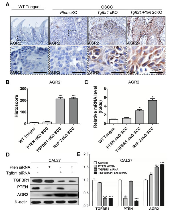 Increased expression of AGR2 is associated with