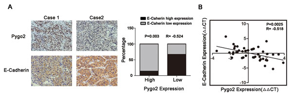 Pygo2 and E-cadherin are inversely correlated in human liver cancer tissues.