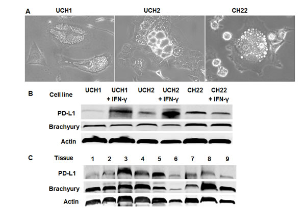 PD-L1 expression in chordoma.
