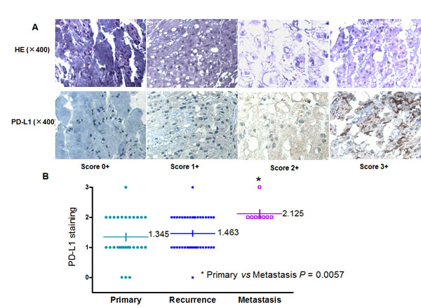 Association of PD-L1 expression with clinical outcome in chordoma.