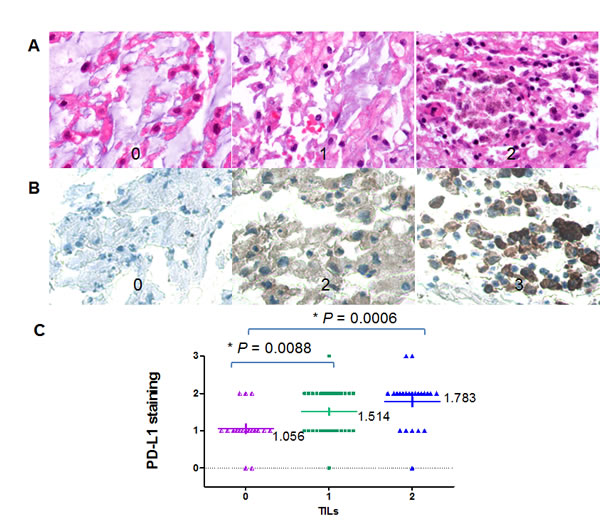 Correlation between PD-L1 expression and TILs by IHC.