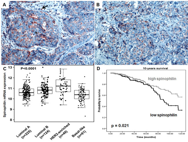 Spinophilin expression in breast cancer tissue and different molecular subtypes.