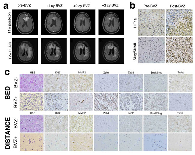 MR imaging and immunhistochemistry of glioblastoma before and after bevacizumab therapy.