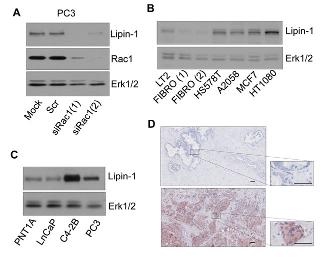 Fig.1: Lipin-1 expression is increased in various cancer cell lines and in prostate cancer samples.