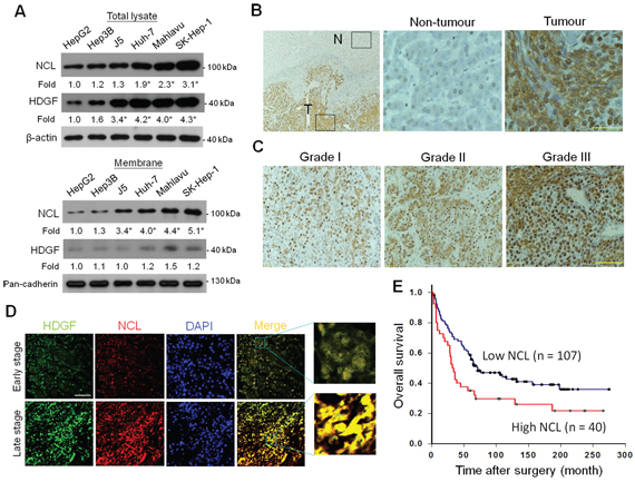 Expression of NCL in human HCC tissues and its association with tumour grade and the survival outcome.