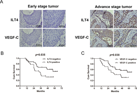 Co-expression of ILT4 and VEGF-C in NSCLC tissues.